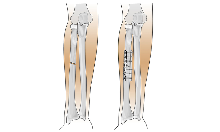 हड्डियों के फ्रैक्चर में जेब तकनीक बेहद कारगर